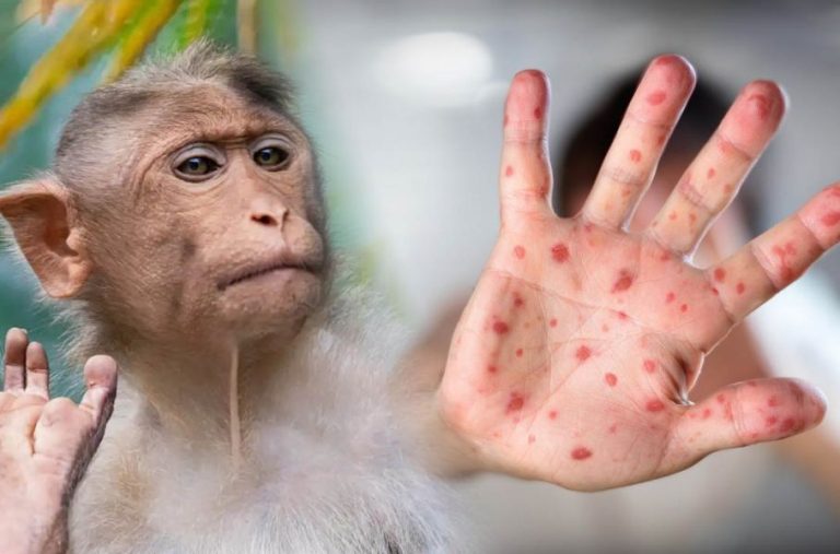 PODRÍA LLEGAR A PARAGUAY LA NUEVA VARIANTE DE LA VIRUELA DEL MONO.