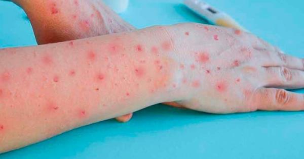 SALUD PÚBLICA ADVIERTE SOBRE PREVENCIÓN CONTRA VIRUELA DEL MONO